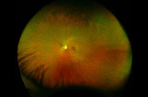 healthy-retina
